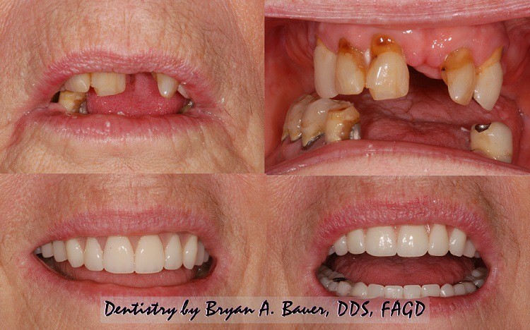 Types Of Dentures Mina NV 89422